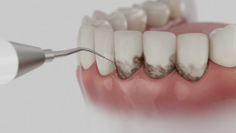 Trusted Dental Implants service in South Miami, FL - Dentist Open Now